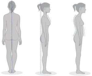 How to Assess Posture